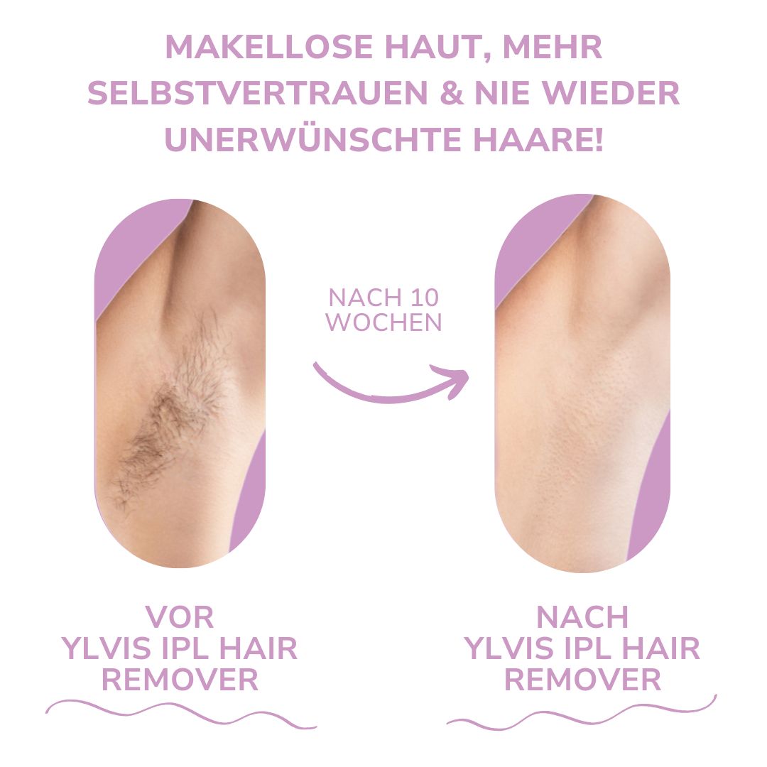 IPL Haarverwijderaar - De Beste Laser-Haarverwijdering voor Thuis